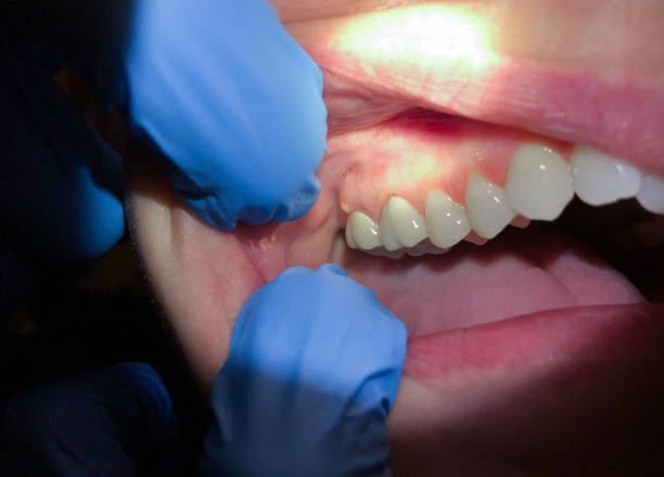 Best Emergency Dental Care for Broken or Chipped Teeth in Sur Hill, GA